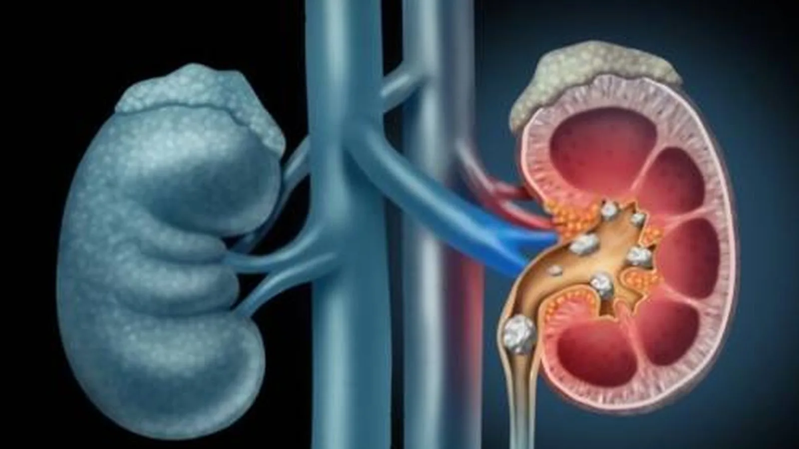 Insuficiencia renal aguda en CDMX: Manejo clínico y recuperación